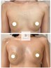 バストアップ人気No.1【美乳】新脂肪増加剤10ml 導入！高濃度特許成分配合☆
