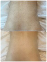 リクラ 北千住(Reclat)/1回ビフォアフターブライダル◎