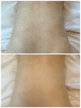 リクラ 北千住(Reclat)/1回ビフォアフターブライダル◎