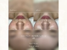 アンド ミヨン(And Miyon)/スキンメイド×毛穴洗浄1回