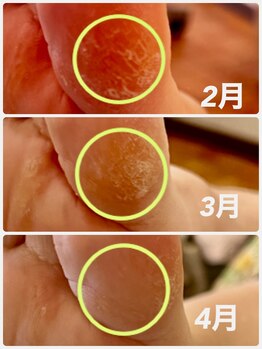 ネイルサロンアンドスクール シーグリーン(SEAGREEN)/親指横の角質