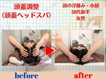 マッチ鍼灸整骨院/ストレスで頭皮が固く感じる方