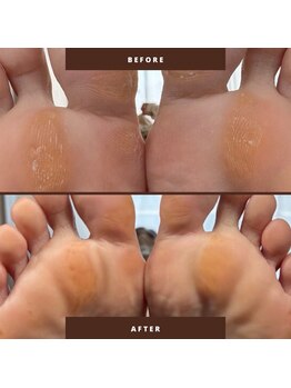 マオヌー(MAONU)/韓国式足裏角質ケア　症例写真
