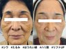 肌質改善No.3〈シワ/たるみ改善〉特許リフトMPFヒアルロン酸小顔フェイシャル