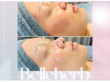 ベルハーブ(Belle herb)/30代/光フェイシャル/美白くすみ