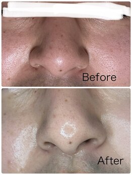 ルミネル 名古屋新栄(Luminelle)/毛穴・美白