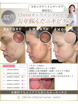 シェリー(Cherie)/【ニキビ】の原因を舌から見る