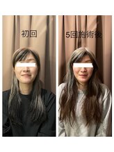 アイリー(Irie)/小顔矯正