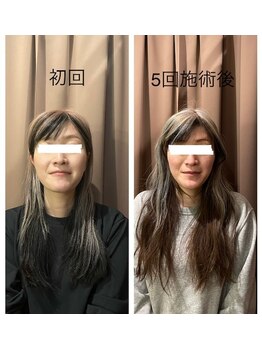 アイリー(Irie)/小顔矯正