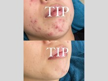 キー(kii)/頑固な顎ニキビケア