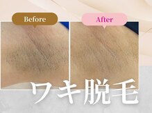 フェルナ 南森町店(FERNA)/脱毛