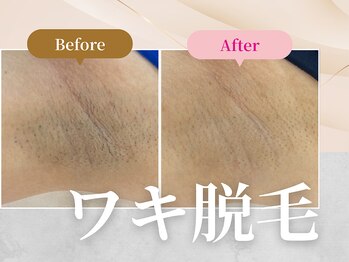 フェルナ 南森町店(FERNA)/脱毛