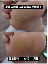 巻き爪じゅん 千葉駅前店/足の角質によるストレスから解放