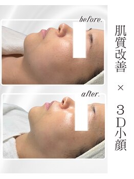 リアム(LiAm)/ララピール×レモンボトル