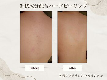 プライベートエステサロン トゥインクル/背骨ラインに出やすいサメ肌改善