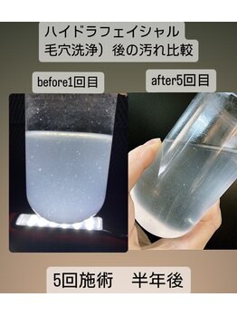 ヴィーナス(Venus)/毛穴洗浄 5回施術(半年後)