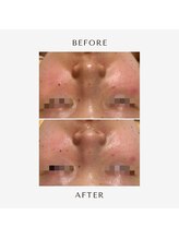 ヒヨリ(hiyori)/《before/after》毛穴洗浄