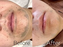 バーニー 梅田店(BARNEY)/ヒゲ脱毛　/脱毛/顔脱毛