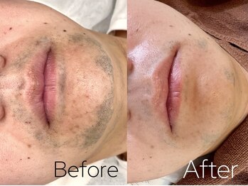 バーニー 梅田店(BARNEY)/ヒゲ脱毛　/脱毛/顔脱毛