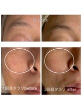 ラペ(la paix)/フェイス症例写真