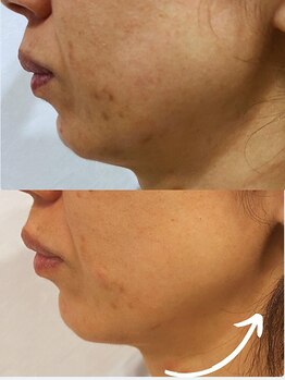 フォーユー 飯能店(Foryou)/レモンボトル1回