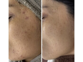 プログレス(PROGRESS)/ニキビケア