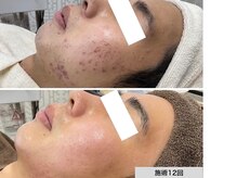 ニキビ研究所 千葉店の雰囲気（改善実績多数！赤み・痕・残ってしまったニキビでお悩みの方へ）