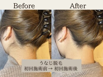 インベスト(INVEST)/うなじ脱毛☆