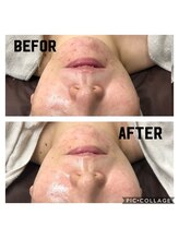 シャルム(CHARME)/ハーブフェイシャル