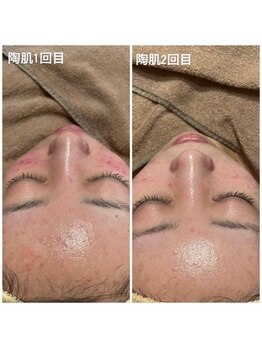 スムー 金沢小橋町店(Smoo)/ハーブピーリング