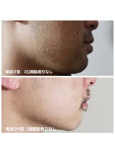 ルイ(Rui)/メンズ髭脱毛　befor after