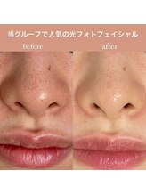 メディカルサロン ティアラ 亀有本店/【光フォト】（黒鼻毛穴）