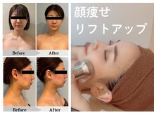 エミット(emit.)の雰囲気（圧倒的な小顔＆リフトアップ効果！人気No1脂肪燃焼剤導入施術）
