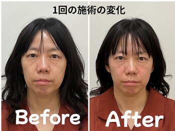 ゆず鍼灸整骨院/当院人気NO1！美容鍼モニター様