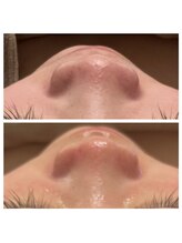 美温(mion)/毛穴ケア