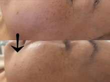 サロン ドロップ 上小田井(Salon drop)/「シミ改善」途中経過