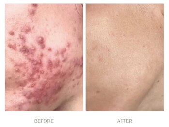 ラシェ プリズ 心斎橋の写真/【大人のニキビ（跡）・凸凹】厚塗りで隠すのを卒業。お肌を土台から入れ替えるケア[心斎橋駅7分]