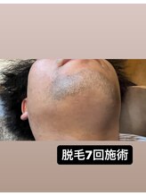 モアナ 前橋店(Moana)/ヒゲ脱毛