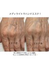 ハンドエステ