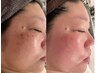 【毛穴レスたまご肌へ♪】フェイシャルワックス脱毛+毛穴洗浄　1回¥18000