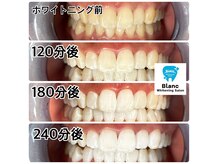 3日（回）合計240分のホワイトニングの時間変遷例