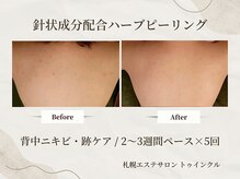 プライベートエステサロン トゥインクル/背中の上部のくすみ、茶色い跡に