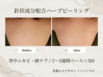 プライベートエステサロン トゥインクル/背中の上部のくすみ、茶色い跡に