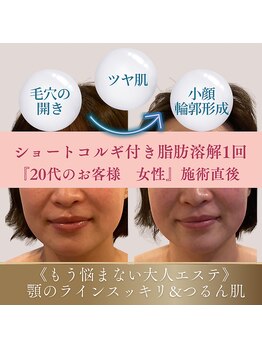 アンシャンテ(Anchant)/【半永久的に脂肪分解】