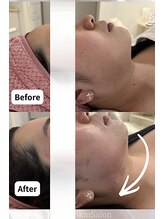 マウム(Maum)/フェイスラインすっきり