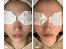 サロン ド ラム/【韓国PDTコース】5回目