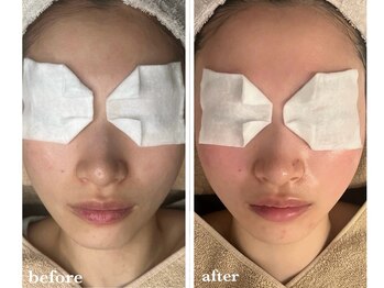 サロン ド ラム/【韓国PDTコース】5回目