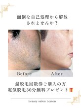 ビューティーサロンレモン(Lemon)/髭脱毛