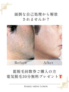 ビューティーサロンレモン(Lemon)/髭脱毛