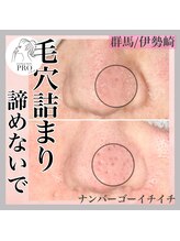 ナンバー511(No.511)/毛穴詰まり改善/メンズエステ